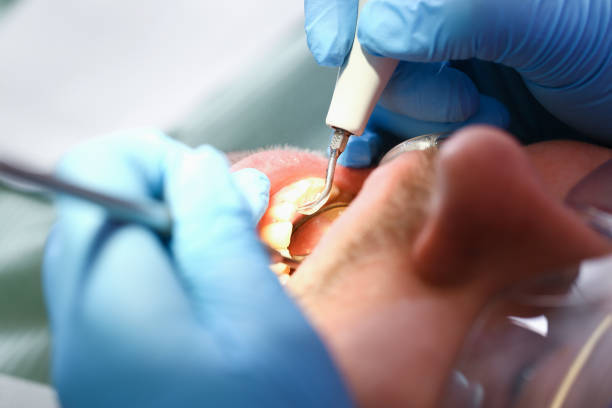 Best Emergency Root Canal Treatment in Masonville, KY